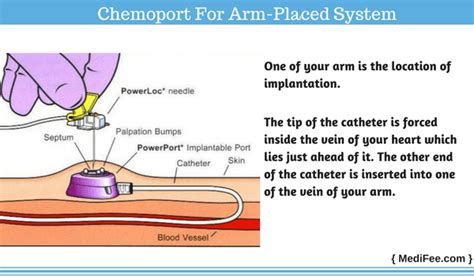 Chemo port accessed via superhero cape protocols